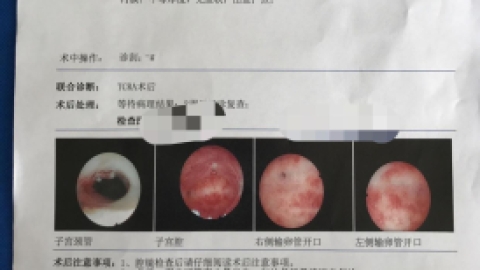 宫腔粘连术后2年不复粘，要怎样才能做到？