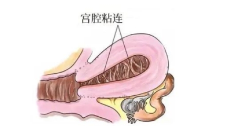 聊聊备孕路上的拦路虎——宫腔粘连