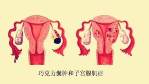 巧克力囊肿真的无法根治？