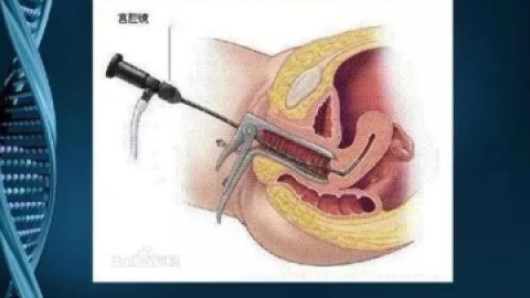 宫腔粘连怎么处理