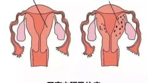 女性子宫腺肌症是一种什么体验？