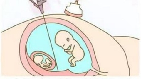 双胞胎越来越多 专家：不应盲目追求多胎妊娠