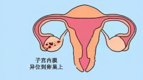 巧克力囊肿产生原因 主要有五个原因更新时间:2018-02-