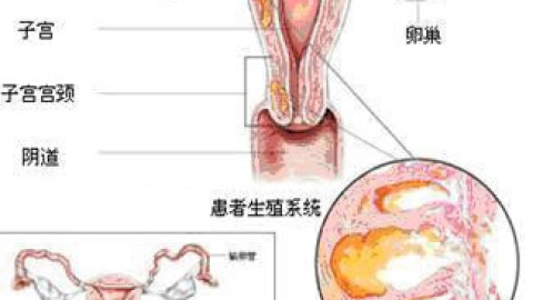 子宫腺肌症的治疗方法