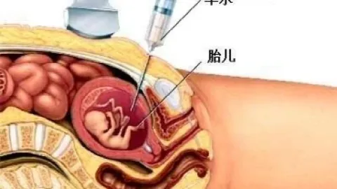 我国的唐氏综合症发病几率很高么？