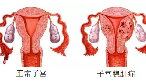 得子宫腺肌症的9种原因，你觉得自己是哪一种？
