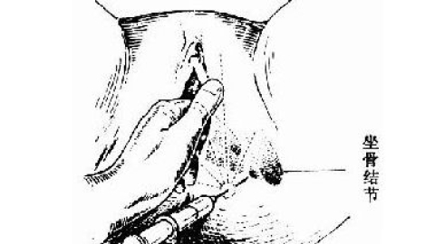 直击会阴侧切手术全过程(组图)