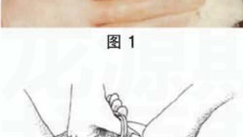 会阴侧切的术后护理及并发症处理方法(期刊论文)