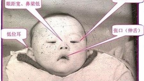 这7类夫妇最易生“唐氏综合症”儿