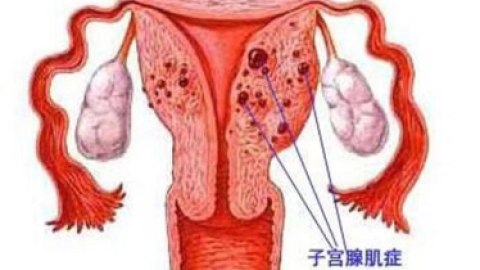 子宫腺肌症是怎么形成的？