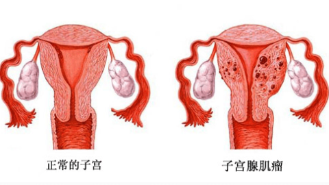 子宫腺肌症新的治疗方法！