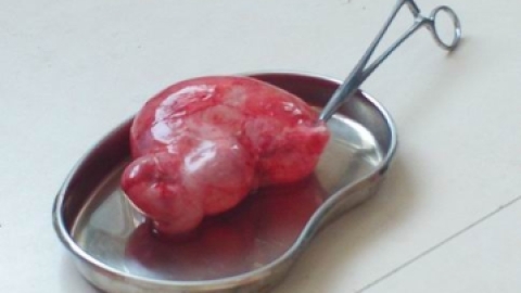 巧克力囊肿一般在什么情况下会破裂或卵巢囊肿蒂扭转？？
