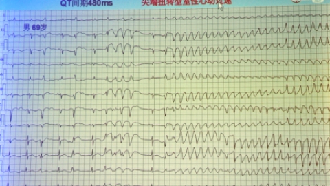 西酞普兰致QT间期延长并尖端扭转型室速一例
