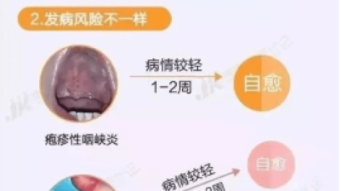 春季疱疹性咽峡炎高发期！比手足口病还厉害！