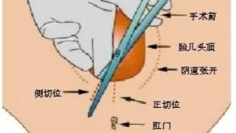 顺产侧切真的很可怕吗？侧切后的护理更重要（超详细）