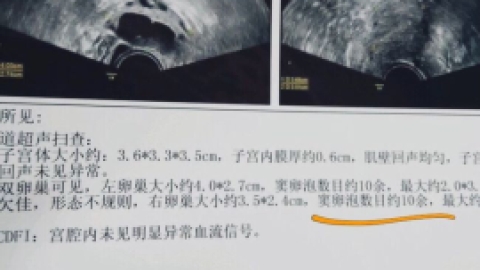 窦卵泡计数 在英语中的定义：Antral Follicle Count