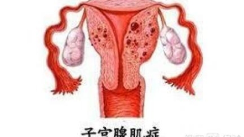 子宫腺肌症常见的并发症