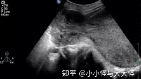 “施肥”日记：子宫内膜6mm算薄吗还会怀孕嘛