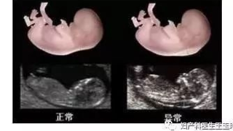 想做NT检查，需要注意什么？