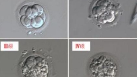 俄罗斯第三代IVF辅助生殖优势：多囊卵巢综合征患者怀孕策略与成功率解析